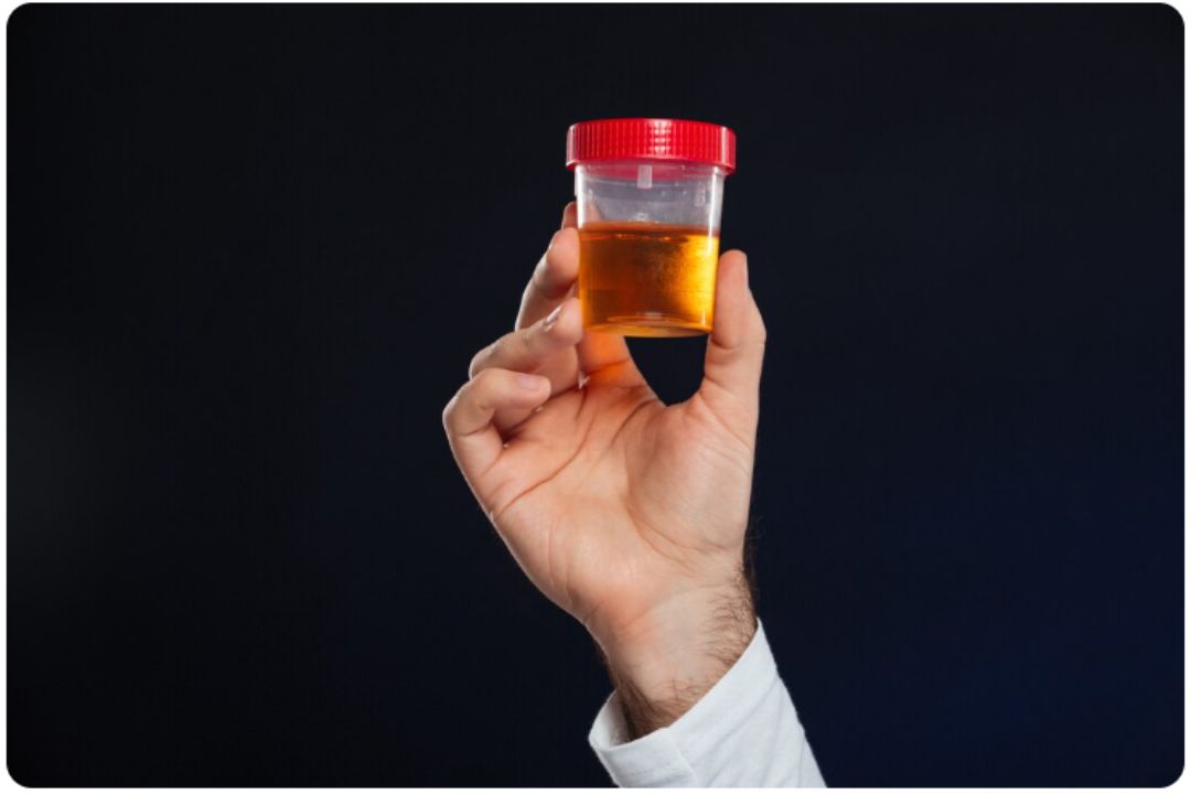 Urobilinogen in Urine